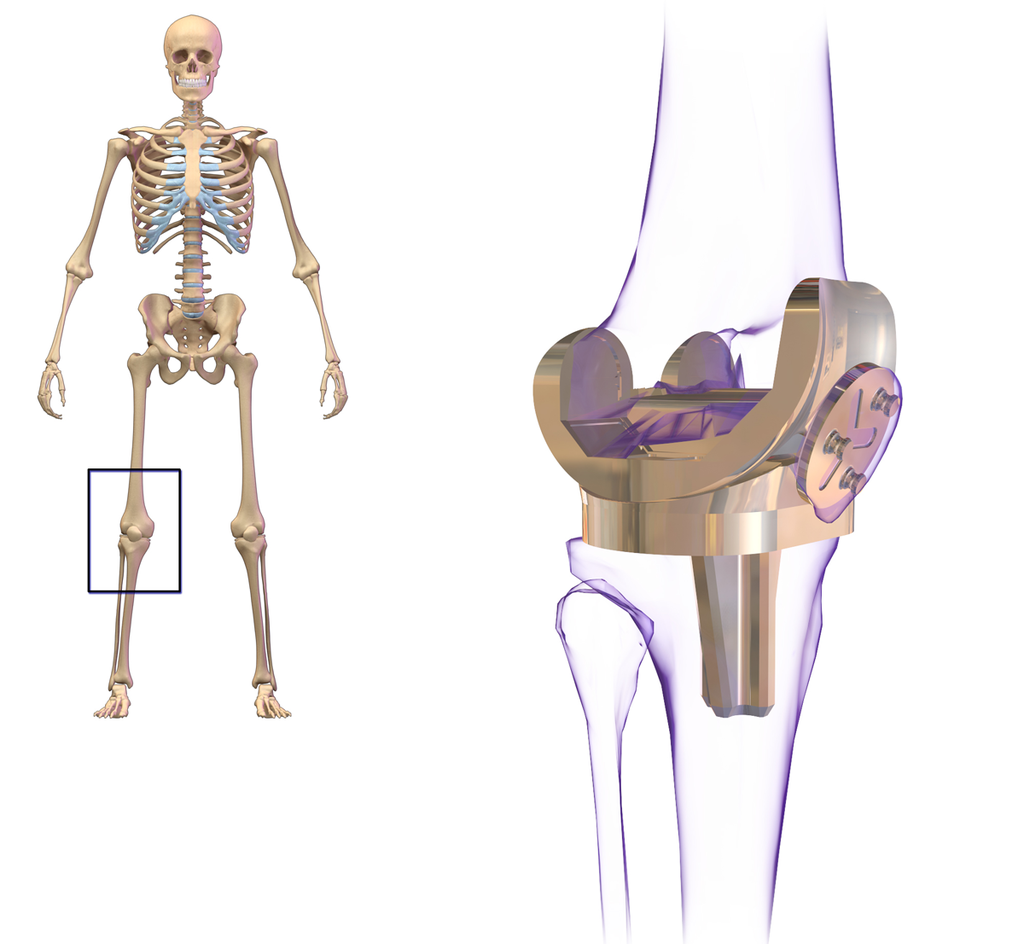 New Gold Compound To Be Used In Replacement Knee and Hip Joints