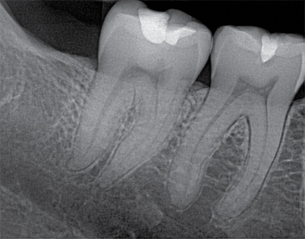 The use of CMOS imagers in dental X-ray devices reduces susceptibility to electrical noise and gives dentists images they can manipulate to make more accurate diagnoses.