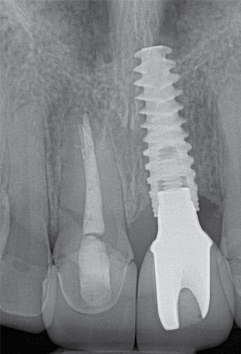 An X-ray by one of Sirona’s CMOS-based digital X-ray devices shows a tooth implant. Through Schick Technologies, which it acquired in 2006, the company holds an exclusive license for use of the NASA-invented technology for dental imagery.