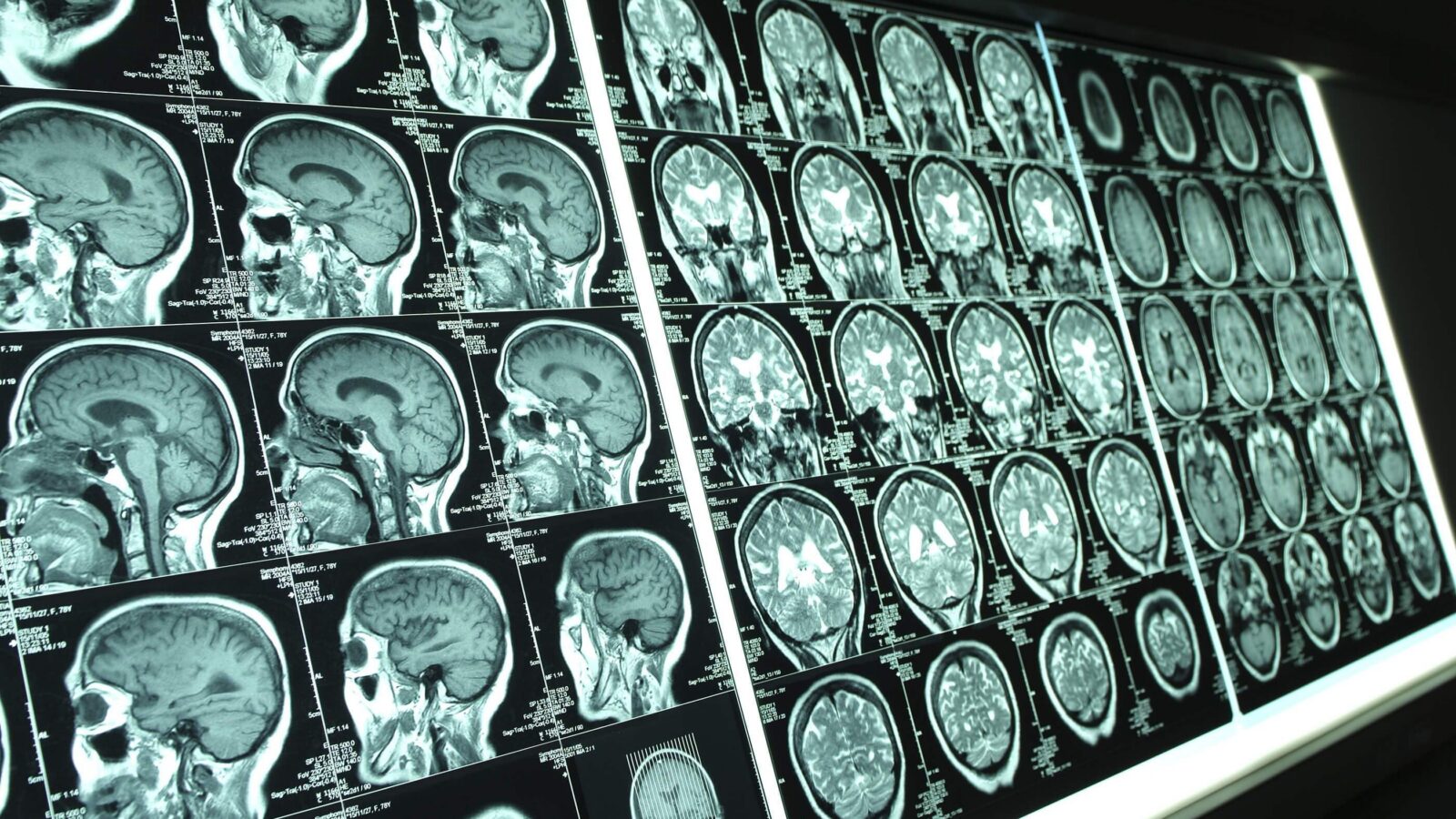 Scientists Discover Brain Vessel Disease Links To Alzheimer’s