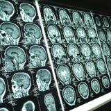 Scientists Discover Brain Vessel Disease Links To Alzheimer’s