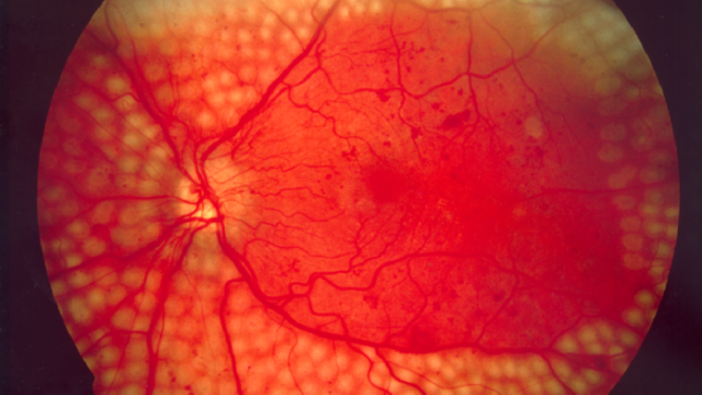 Disease Diagnosing Google’s Deep Learning Technology Have Better Accuracy than Doctors