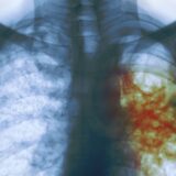 Breakthrough in Tuberculosis Treatment Comes in the Form of Bacterial Proteins