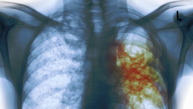 Breakthrough in Tuberculosis Treatment Comes in the Form of Bacterial Proteins