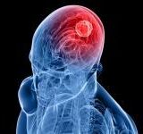 Researchers Find an Enzyme That Feeds Brain Tumors