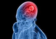 Researchers Find an Enzyme That Feeds Brain Tumors