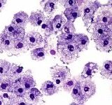 This New Research May Slow Down, and Even Halt, the Spread of Cancer Cells
