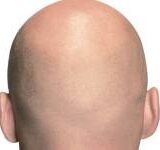 Scientists Discover New Hair Growth Technique Using Stem Cells