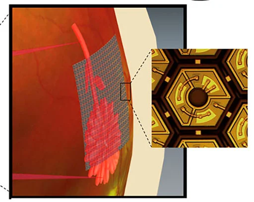 Is the Cure for Blindness Hiding in Video Goggles and an Implant?
