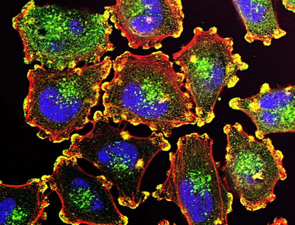 Researchers Use Lasers to Fry Cancer Cells