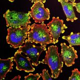 Researchers Use Lasers to Fry Cancer Cells