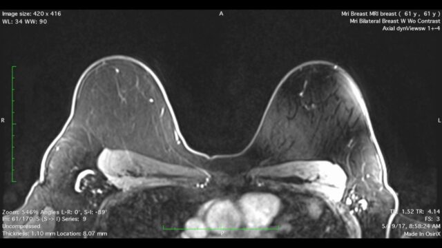 Early Breast Cancer Detection Made Possible Through Artificial Intelligence