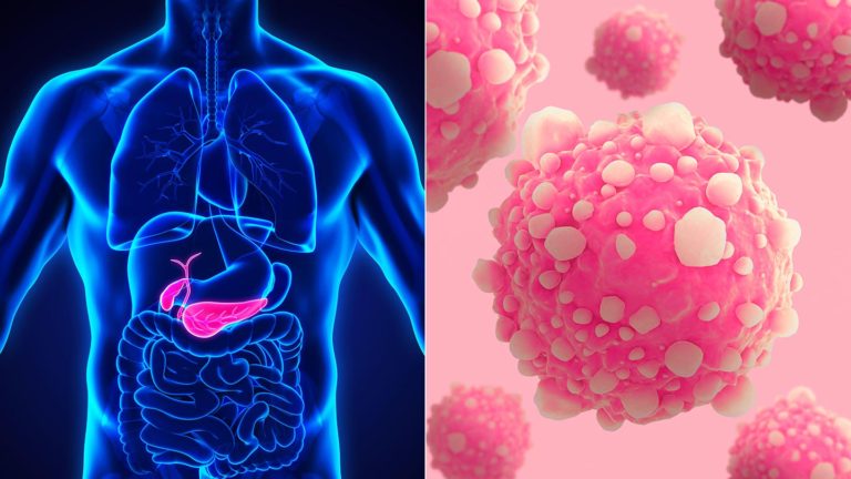 Researchers Discover it May be Possible to Prevent Spreading of Pancreatic Cancer