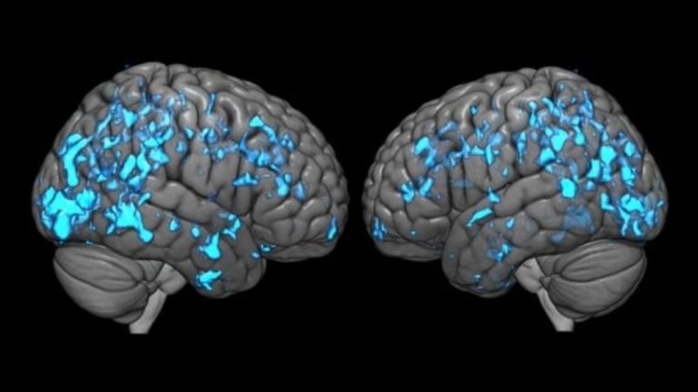 Is Fecal Transplantation the Way to Go When Treating Parkinson’s Patients?