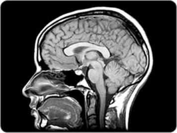 Using Artificial Intelligence to Ramp up the Resolution of Brain MRIs