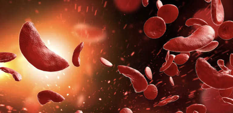 Gene Therapy Breakthrough: Promising Treatment for Sickle Cell Disease and Beta Thalassemia